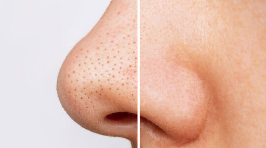 pores dilatés hydrafacial avant après